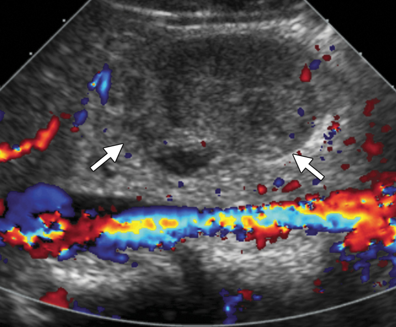 Duodenal hematoma in a 15-year-old boy